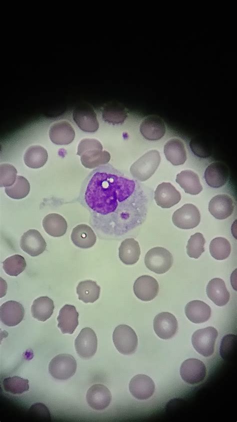 Monocyte Phagocytosing A Platelet Hematology