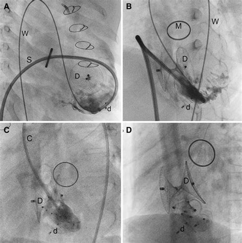 Angiography And Fluoroscopic Imaging Surrounding The Cardiac