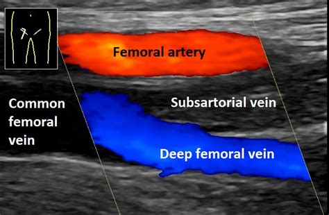 Fileultrasonography Of Deep Vein Thrombosis Of The Femoral Vein