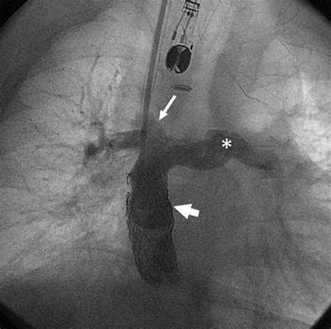 The Kawashima Operation With Simultaneous Preparation For Transcatheter