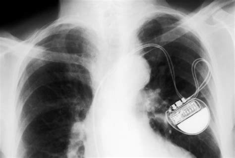 New Device Could Use Heartbeats To Power Pacemakers Redorbit