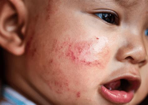 Alergi Kulit Pada Bayi Dermatitis Atopik Gejala Faktor Risiko Dan