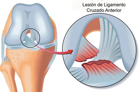 ruptura o lesión de ligamento cruzado anterior ortopedia puebla