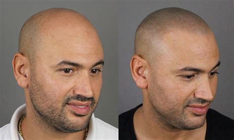 Hair Tattoo Scalp Micropigmentation Cost Before And After Pics