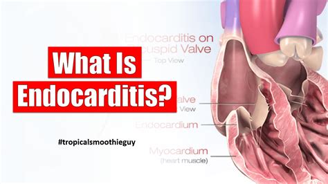 What Is Endocarditis