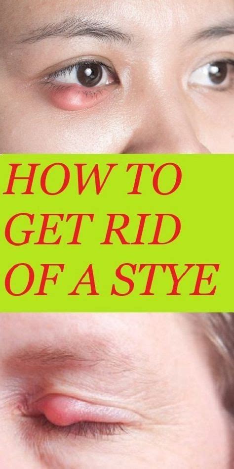 How To Get Rid Of A Stye Howtogetridofeyestye Eyestyepop Eyestyecure
