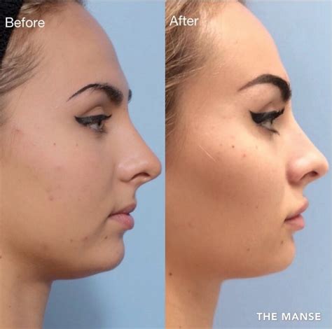 Jawline Slimming Best Clinic Sydney For Dermal Fillers