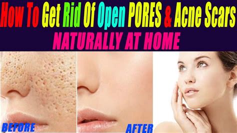 How To Get Rid Of Large Open Pores Permanently Remove Acne Scars