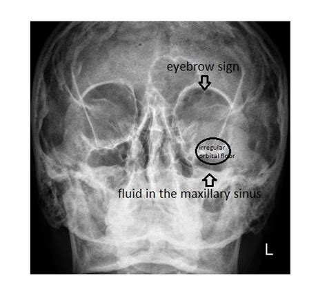 orbital fracture blow ray left wall maxillary sinus floor medial face imaging answer case week facial margin fractured infra emergucate