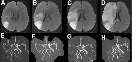Figure 1 From Malignant Middle Cerebral Artery Infarction Resulting