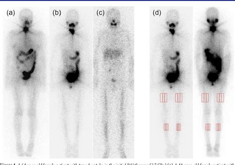 Radioactive Iodine Scan