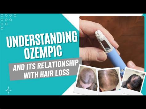 Ozempic The Relationship Between Weight Loss And Hair Loss Zoy Salon