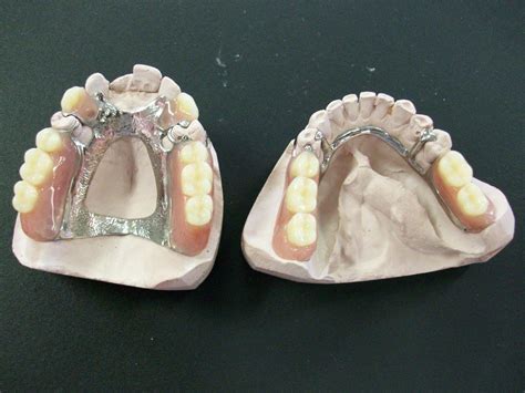 Cast Partial Dentures All You Need To Know About Cast Partial Dentures