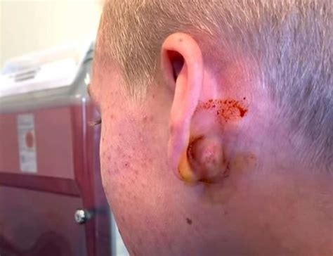 Abscess Behind Ear Archives New Pimple Popping Videos
