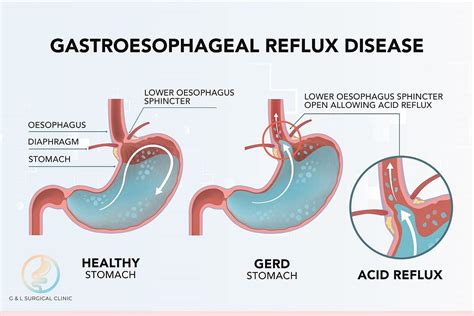 Always Suffering From Heartburn Or Acid Reflux You May Have A