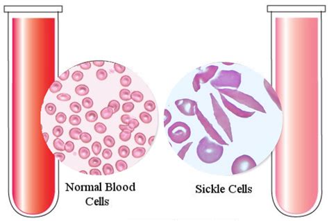 Biology Behind Sickle Cell Disease Science In The City