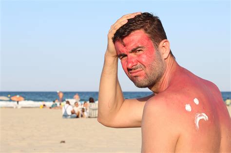 how to best treat sunburn in australia lfa first response