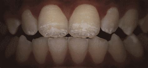 Horizontal White Lines On Teeth Teethwalls