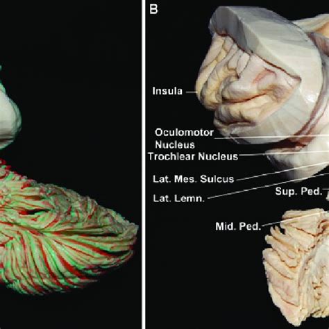 Anterior View Of The Brainstem Cer Ped Cerebral Peduncles Decu