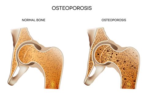 Osteoporosis Vs Osteopenia Whats The Difference Back To Health