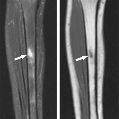 A Location Of Tibial Diaphyseal Stress Fractures B Radiograph Of