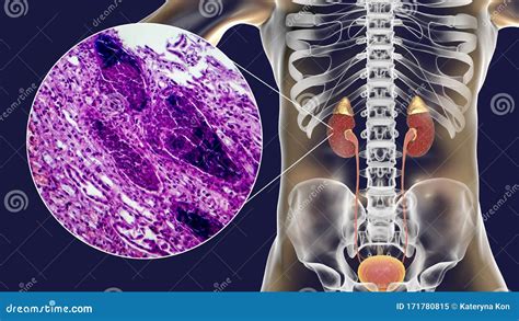 Acute Pyelonephritis Gross Morphology And Histopathology Stock