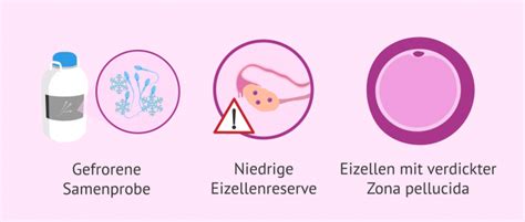 468 x gesehen1 antworten0 bewertungen. Intrazytoplasmatische Spermieninjektion (ICSI): Ablauf ...