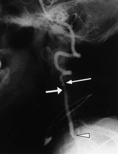 Vertebral Artery Dissection Spectrum Of Imaging Findings With Emphasis On Angiography And