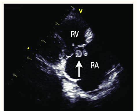 Echocardiographic Modified Right Ventricular Inflow View Showing The