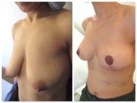 Lipofilling mammaire Turquie prix déroulé et clinique lipofilling seins