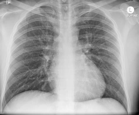 There is a degree of hyperinflation as evidenced by both increased retrosternal airspace and somewhat flattened and depressed diaphragms. Normal trauma chest, pelvis and spine imaging | Image ...