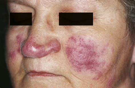 Symptoms Of Lupus