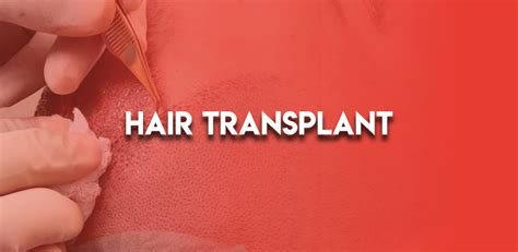 Hair Transplant Clinicexpert International Healthcare Services
