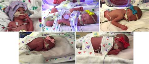 Thriving First All Girl Quintuplets In U S Are Born In Texas Nbc News