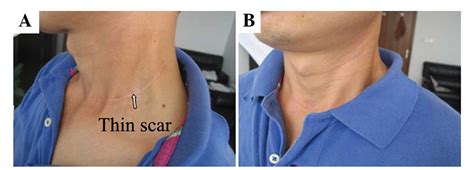 Application Of A Cervical Low Incision In The Functional Neck