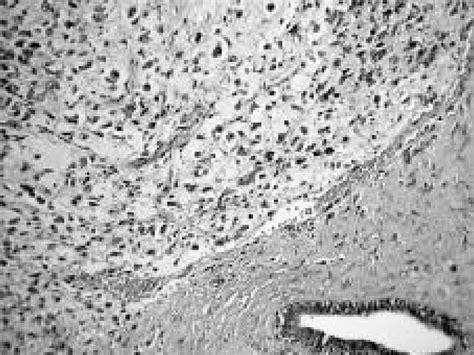 Pure Mucinous Carcinoma Tumour Cells Float In Mucin Lakes Hande 100
