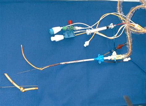 Removal Of Pulmonary Artery Catheter Knotted During Placement By Using