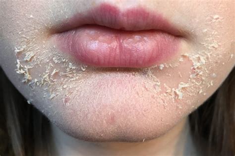 Why It Is Dry Skin Around Mouth Learn Causes And Cure Naturally