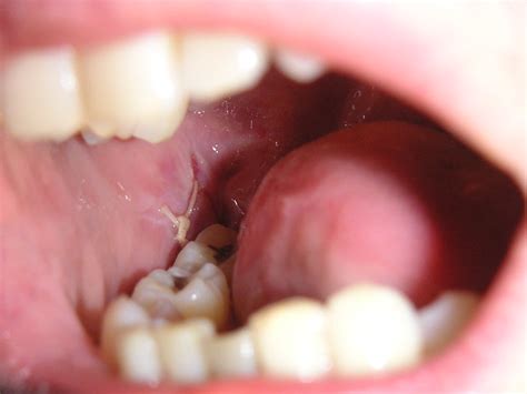 What Is The Likelihood Of Dry Socket After Wisdom Teeth Removal