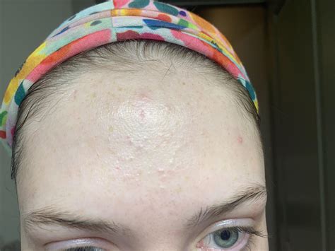 Skin Concerns Any Thoughts On What Is Going On With My Foreheadhow