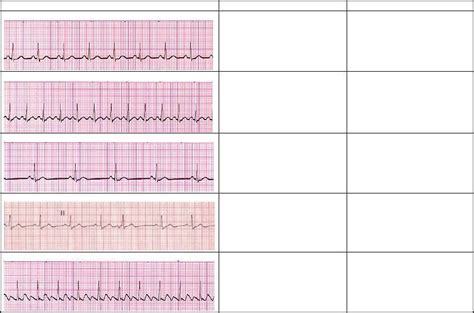 Cardiac Dysrhythmias Electrocardiography Cardiovascular System