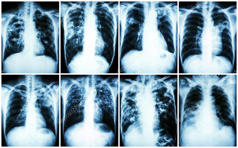 Colección de tuberculosis pulmonar Radiografía de tórax muestra