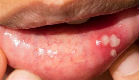 Canker Sore Vs Oral Cancer 3 Key Differences Md Anderson Cancer Center