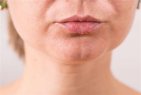 What Causes White Bumps On Lips How To Treat It