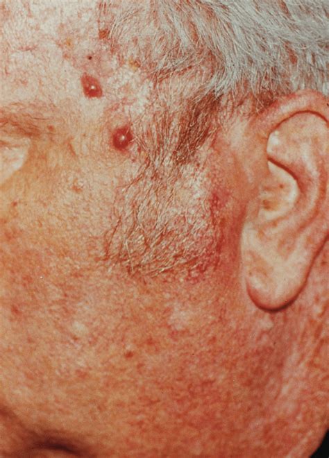 Merkel Cell Carcinoma Pictures Seed And Soil Pharyngeal Merkel Cell