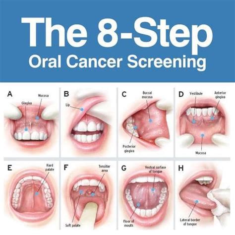 Papilloma Throat Key Features And Symptoms Papillomas