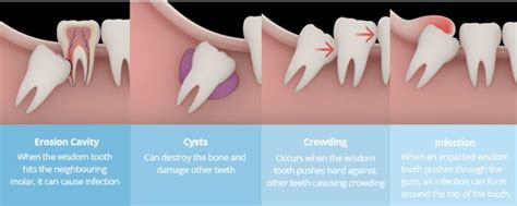 wisdom tooth extraction removal in bangkok thailand