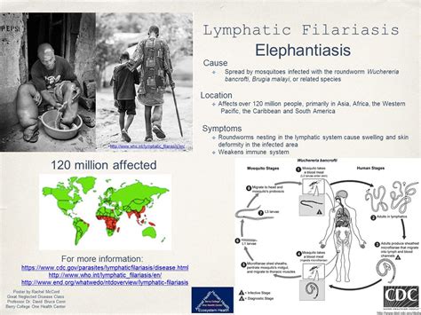 Filariasis Symptoms Images Symptoms Of Disease