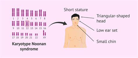 What Is Noonan Syndrome