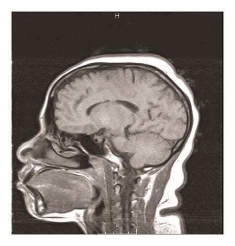 Sagittal T1 Diffusion Weighted Mri Of The Pituitary Gland Download Scientific Diagram